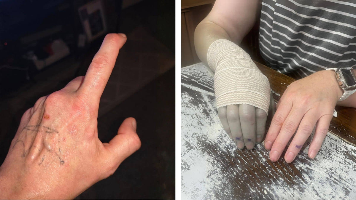 Trigger finger anatomy illustration placeholder